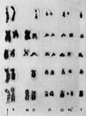 Rowley's 1973 partial karyotype showing the 9;22 translocation